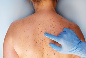 skin-cancer-treatment-featured